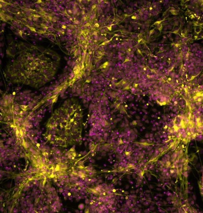 Fluorescently labelled mutant stem cells differentiated toward sympathetic neurons. Image recorded by Dr. Ingrid Saldana