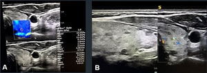 Gray-scale features of markedly hypoechoic thyroid nodule with irregular margin (TIRADS-4), confirmed as papillary thyroid carcinoma