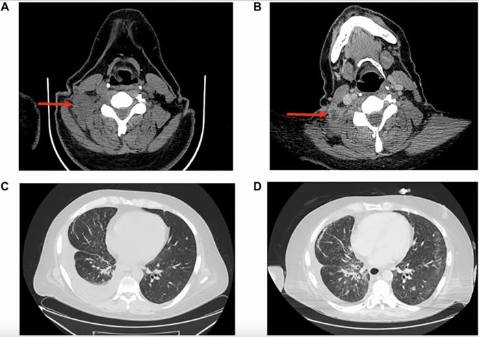 Acquired RUFY1-RET rearrangement as a mechanism of resistance to lorlatinib in a patient with CD74-ROS1 rearranged non-small cell lung cancer: A case report