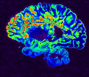 MRI brain scan