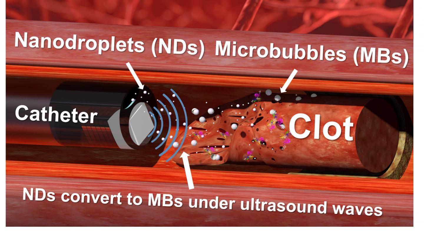 New Technique for Busting Blood Clots