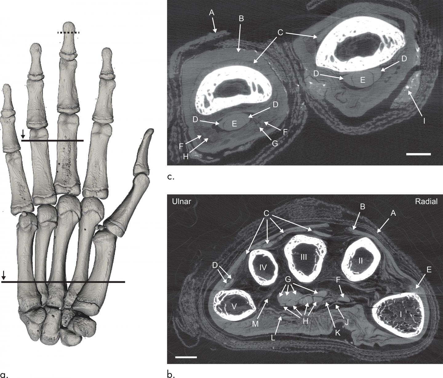 Images Show CT of Mummified Hand.