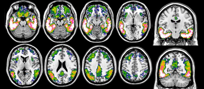 Tau-PET : a window into the future of Alzheimer’s patients