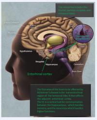 Affects of Alzheimer's on the Human Brain