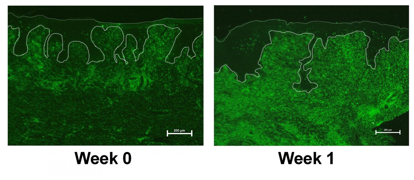 How Skin Substitute Heals Chronic Wounds Finally Uncovered