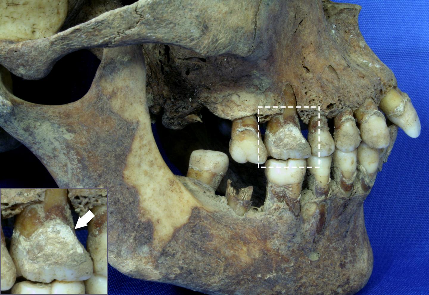 Dentition of a 26-35-Year-Old Female