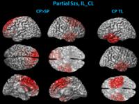 Brain Scans - Epilepsy Research
