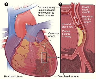 Coronary Artery Disease