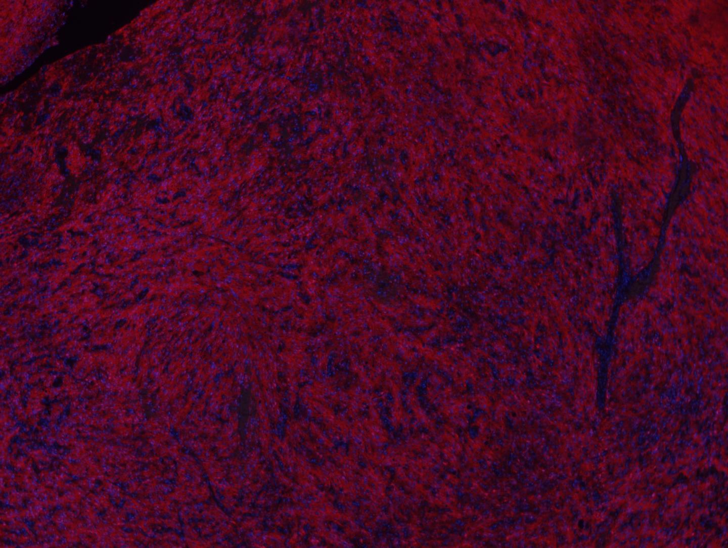 Could There Be a Gleevec for Brain Cancer?