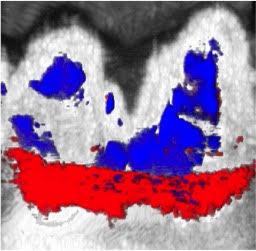 Photoacoustic Ultrasound Dental Image