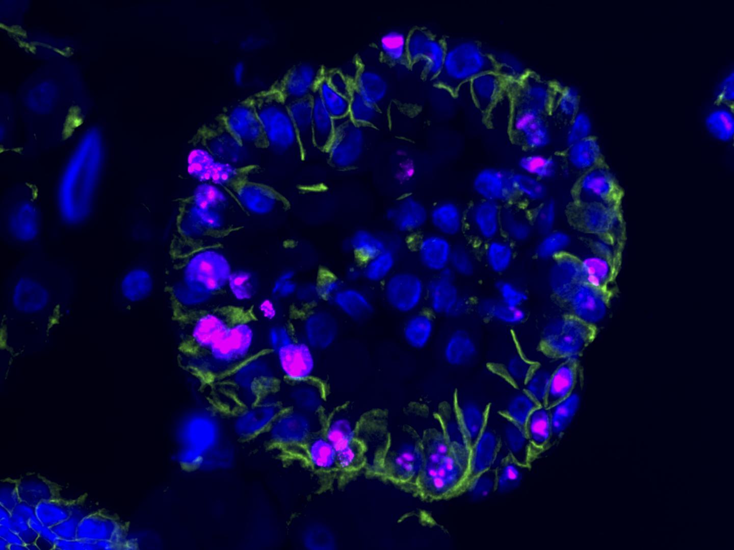 Miniature Kidney Tumors