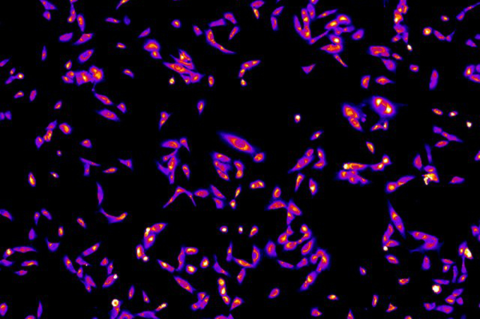 Bioelectric pattern on breast tumor cells