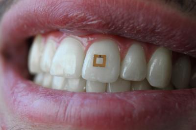 Tiny Sensor Mounted on a Tooth