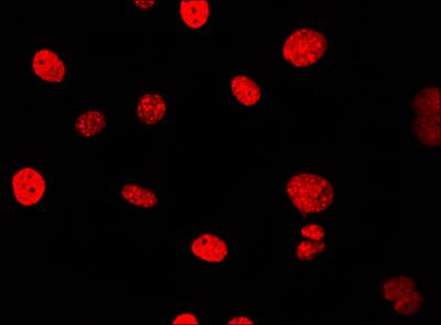 Tumor Cells Containing DNA Damage (Red) after Etoposide Treatment