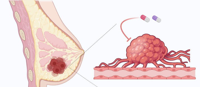 Cancer du sein : facteurs, symptômes et thérapies