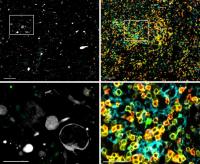 Two-Pronged Gene Therapy for Glioblastoma Proves Safe in Phase 1 Trial (2 of 3)