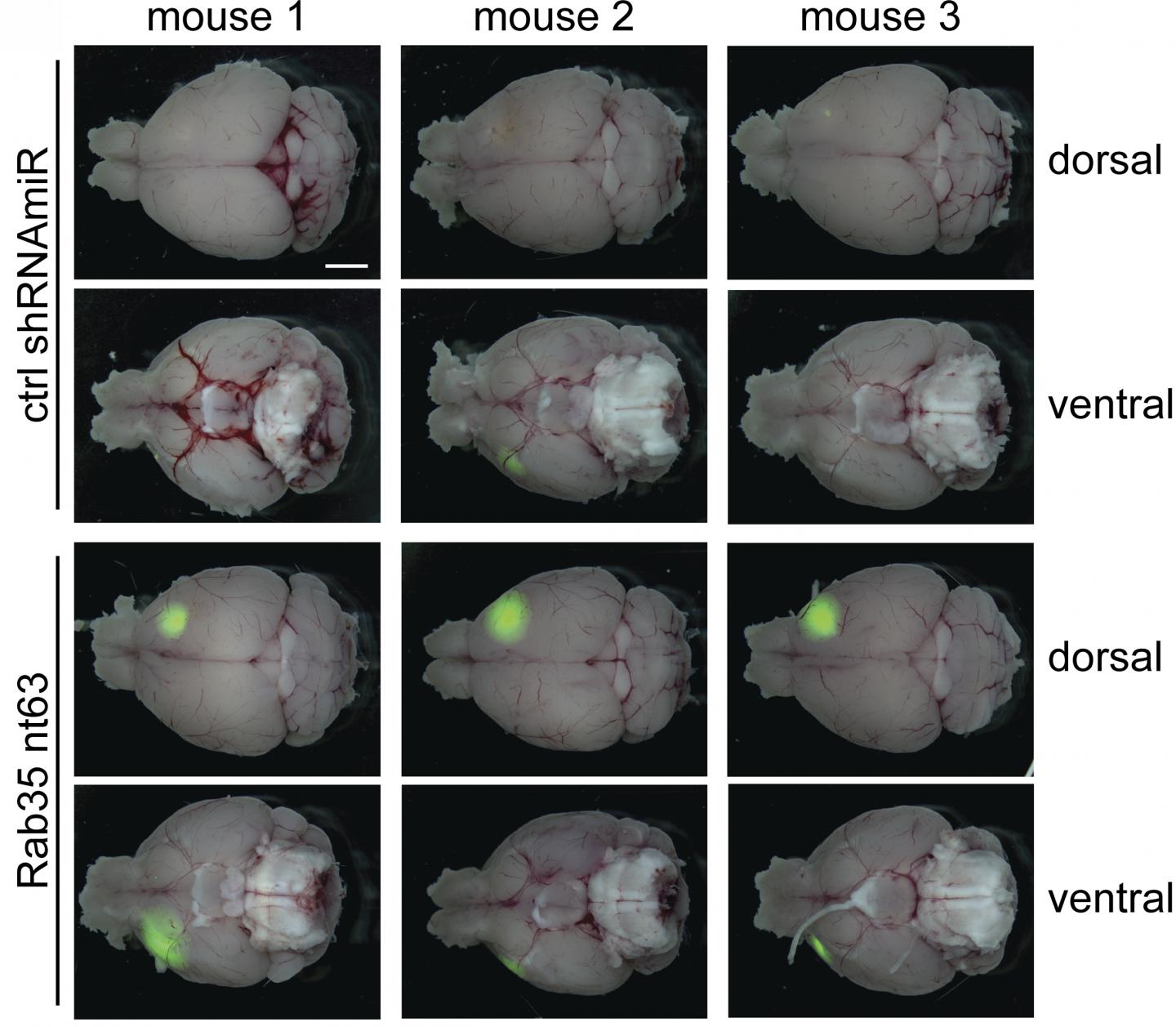 Brain tumors grow faster in the absence of Rab35