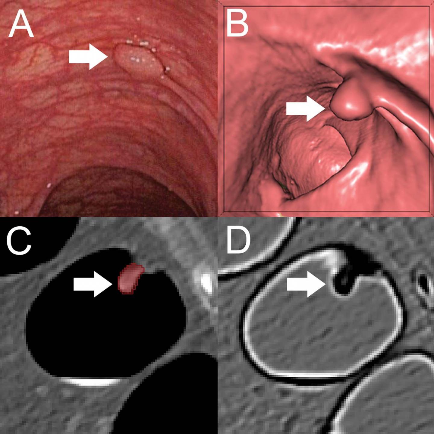 Machine Learning Method Identifies Precancerous Colon Polyps