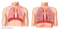 Normal Lung vs. Emphsyema Lung