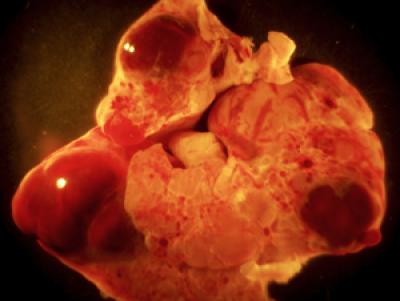 Study Raises Safety Concerns about Anti-Notch Therapy for Cancer