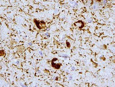 Detecting Alzheimer's Disease