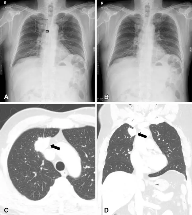 Chest X-rays obtained as part of a health checkup in a 65-year-old male patient.