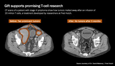 CT Scans Before and After Immunotherapy