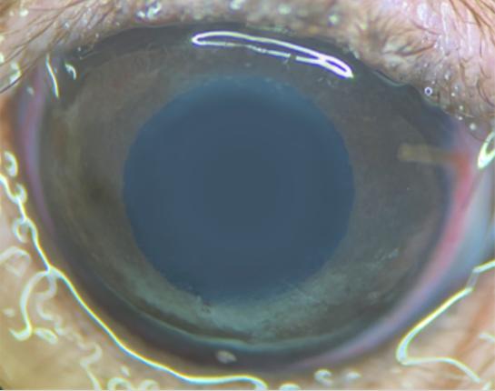 Subject's Eye Impacted with a Cannula