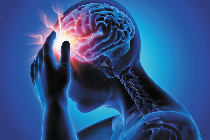 Sudden severe headache a sign of burst aneurysm