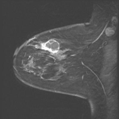 Microwave Imaging Can See How Well Treatment Is Progressing (2 of 2)