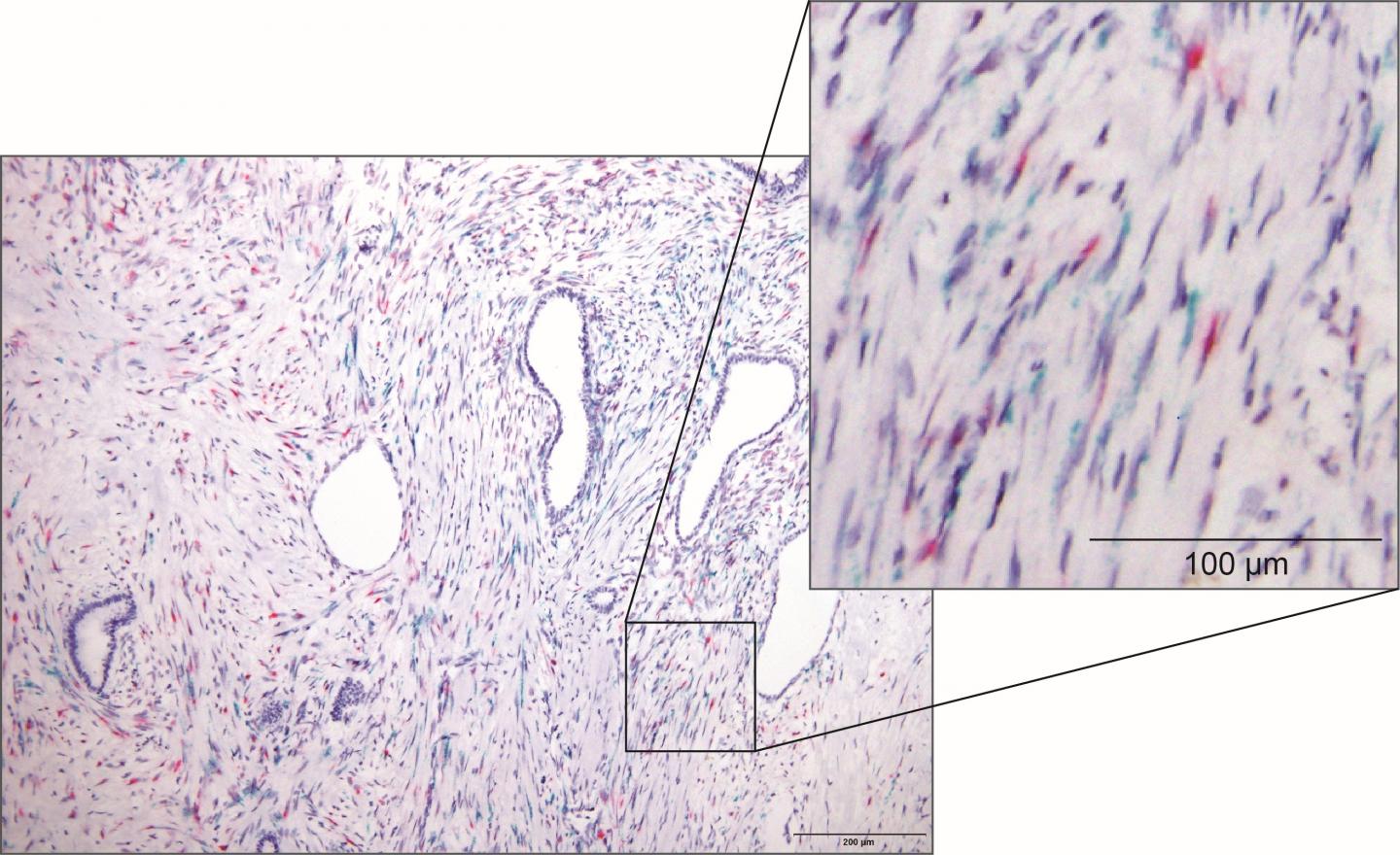 Infiltration of Meflin-Positive Fibroblasts and -Negative Ones in Human Pancreatic Cancer