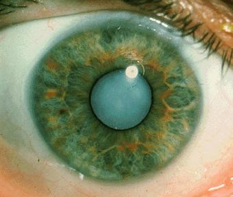 A Protein function that jump-starts cataract formation