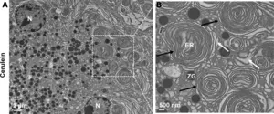 Electron microscopy photographs of abnormal ER structures in acute pancreatitis tissues.