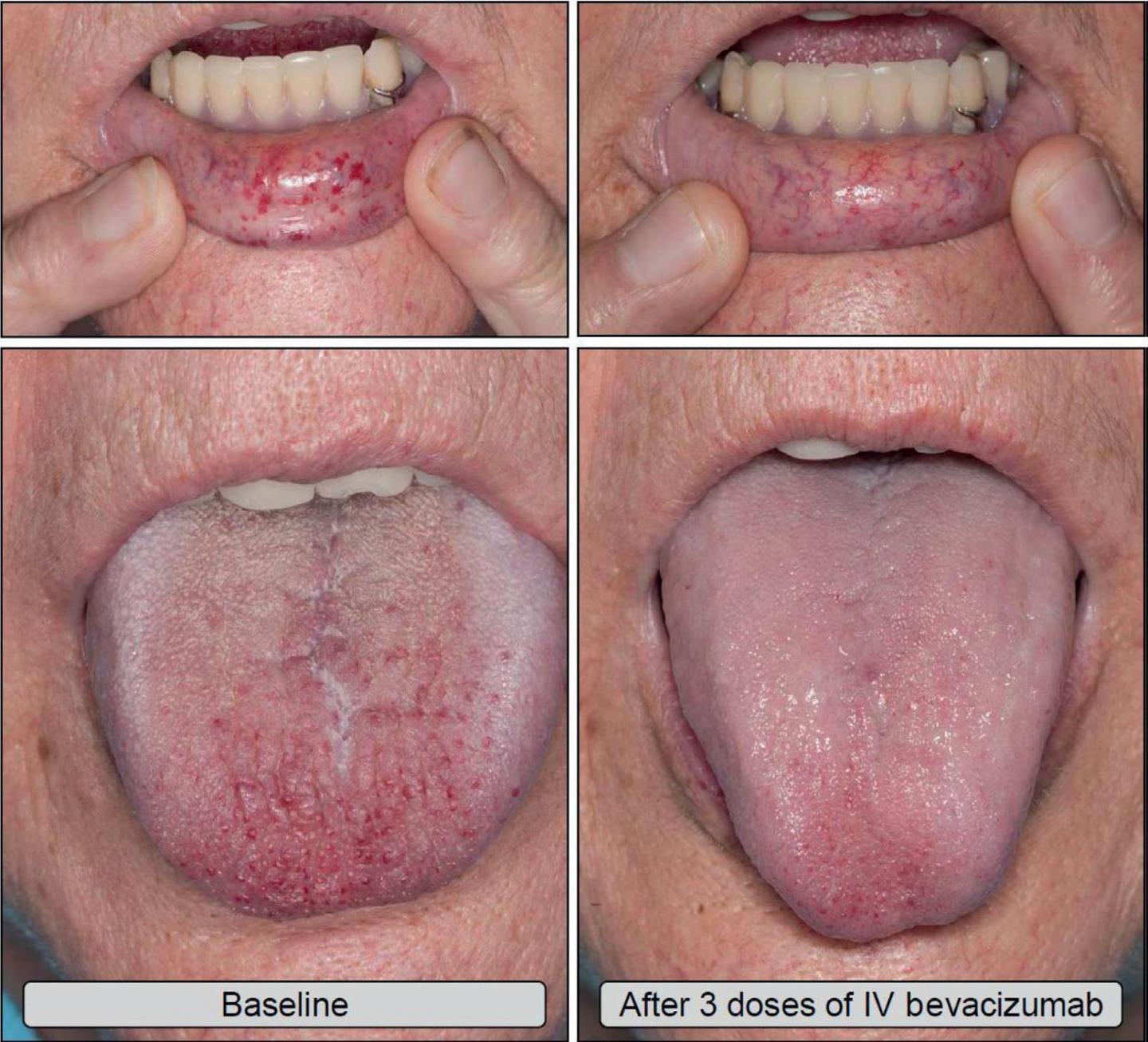Bevacizumab Dramatically Improves Severe Hereditary Hemorrhagic Telangiectasia (HHT) Associated Blee