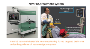 Focused ultrasound may help prevent seizures in some patients with epilepsy