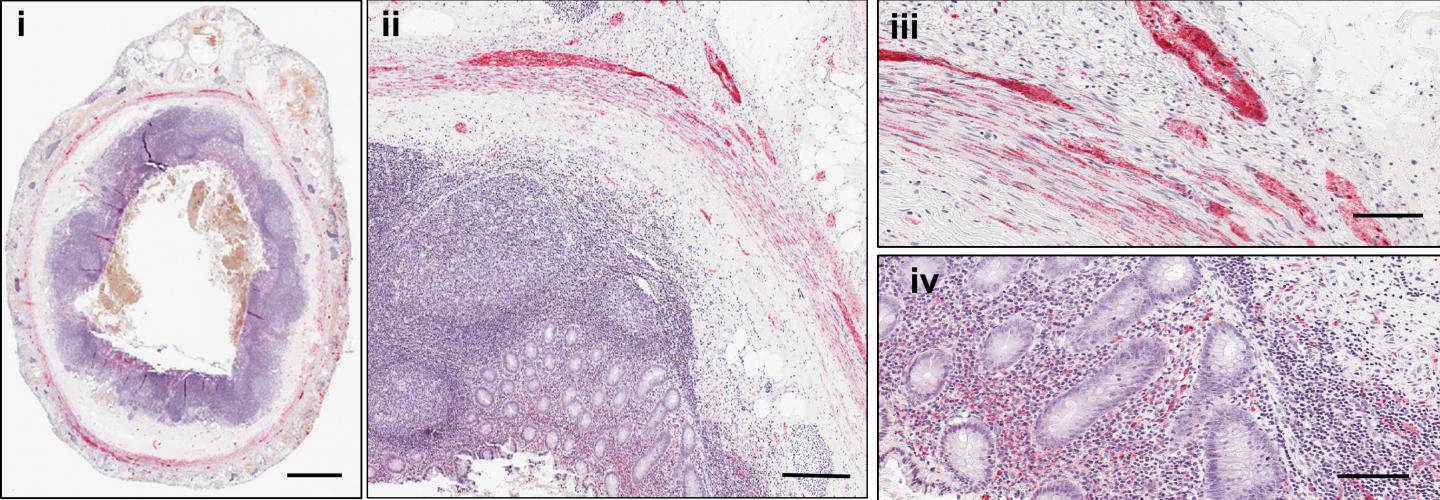 Appendix Removal Tied to Decreased Parkinson's Disease Risk in About 20 Percent of Cases
