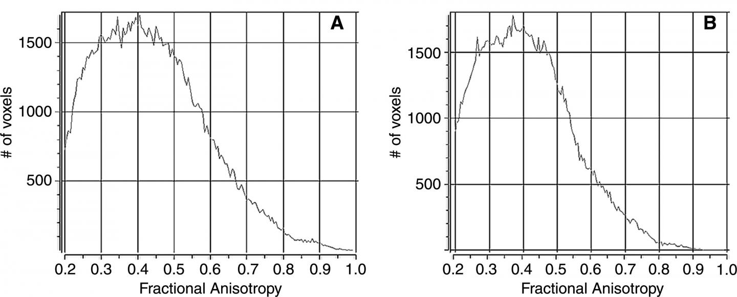 Technique Helps Predict Likelihood Of Migraines In Concussion Patients (1/3)