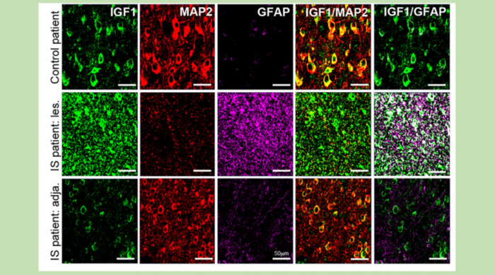 Widespread loss of IGF-1 from cortical neurons and an increase in IGF-1 in the reactive astrocytes adjacent to the lesion