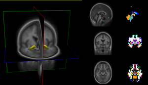 Brain imaging as a tool to study autism spectrum disorders.