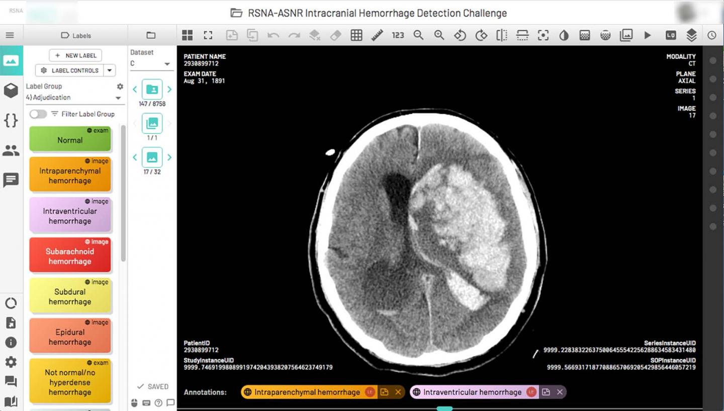 RSNA AI Challenge Breaks New Ground