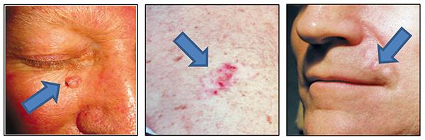 Skin Cancer To Each Tumor Its Particulariti Eurekalert