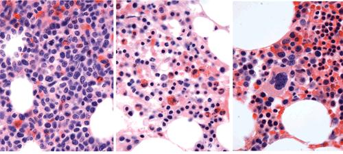 Bone Marrow Biopsy of Patient before and during Treatment with NOTCH Inhibitor Drug