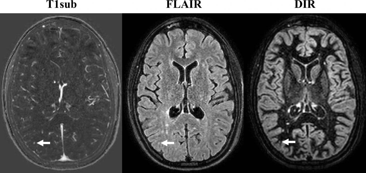 Axial MR Images Obtained in 32-Year-Old Woman with Relapsing-Remitting Multiple Sclerosis