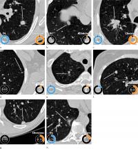 AI Predicts Lung Cancer Risk