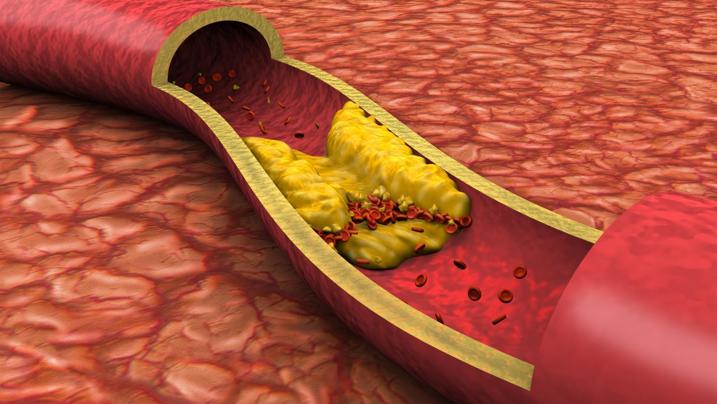 Atherosclerotic Plaque Deposits 