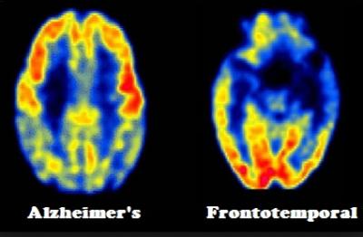 First-of-its-kind Study on Frontotemporal Degeneration Led by FAU