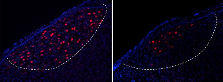 Corticobasal Ganglia Projecting Neurons Disrupted