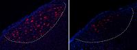Corticobasal Ganglia Projecting Neurons Disrupted