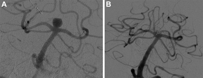 Novel Treatment Effective for Sidewall Brain Aneurysm