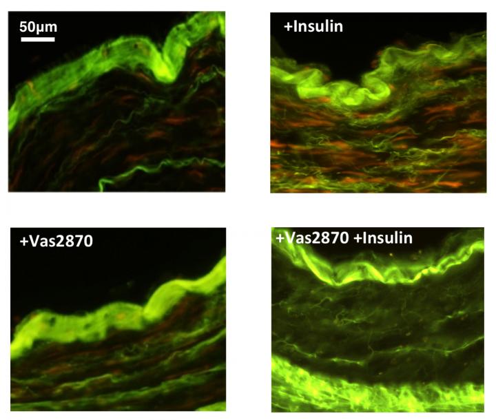A New Strategy to Counter Insulin Damage in Coronary Artery Disease (1 of 2)